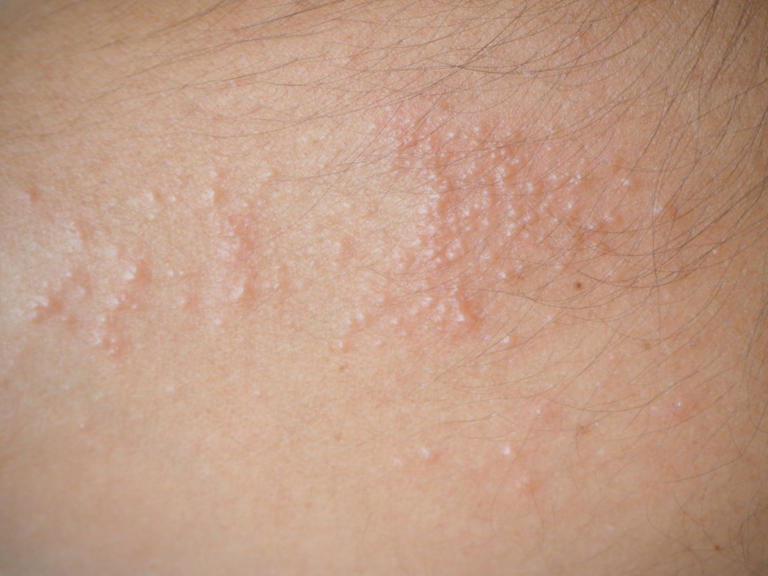 Heat Rash – Why it appears and how to get rid of it! 96