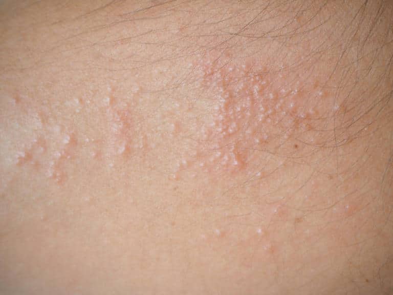 Heat Rash – Why it appears and how to get rid of it! 6