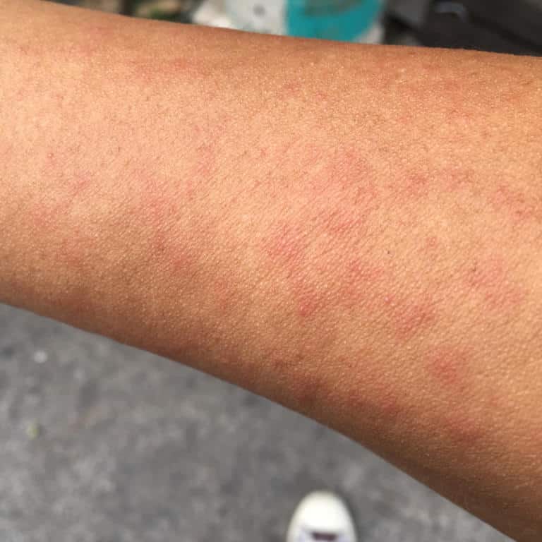 Heat Rash On Arms